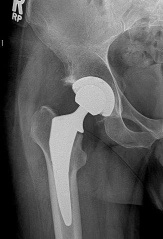 After treatment - Direct Anterior Total Hip Replacement for Avascular Necrosis