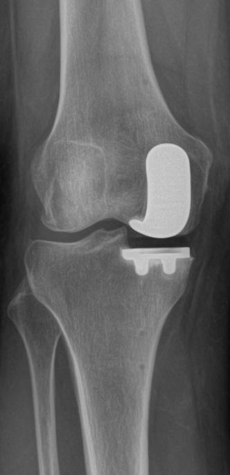 After treatment - Robotic Unicompartmental (Partial) Knee Replacement