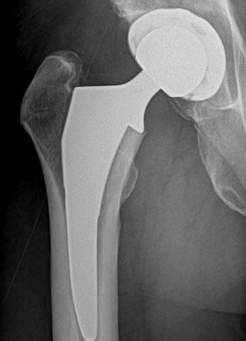 After treatment - Total Hip Replacement