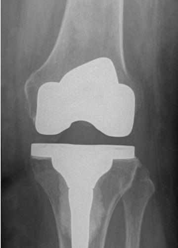 After a Total Knee Replacement