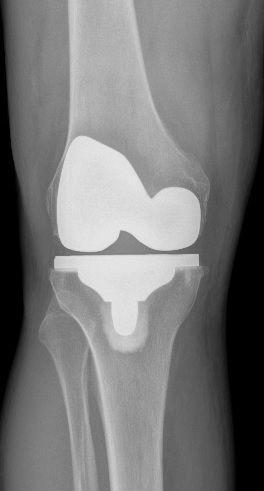 After treatment - Total Knee Replacement