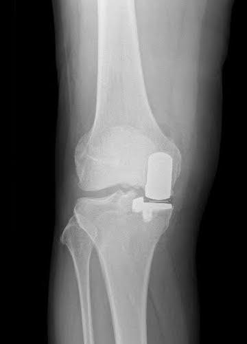 After treatment - Partial Knee Replacement