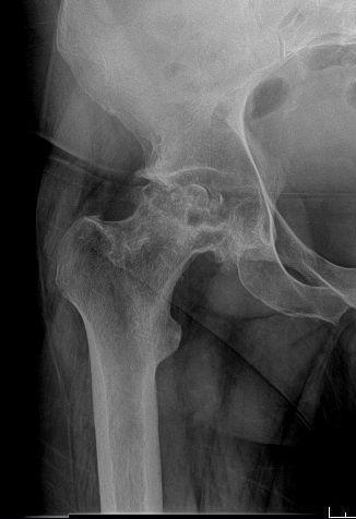 Before treatment - Direct Anterior Total Hip Replacement for Avascular Necrosis