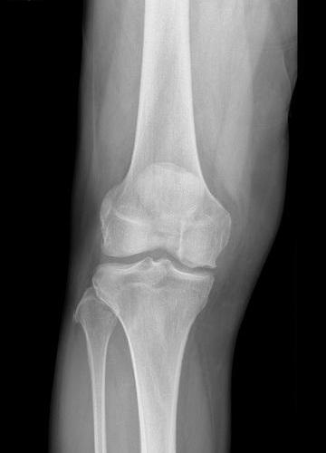 Before treatment - Partial Knee Replacement