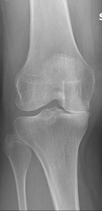Before treatment - Robotic Unicompartmental (Partial) Knee Replacement