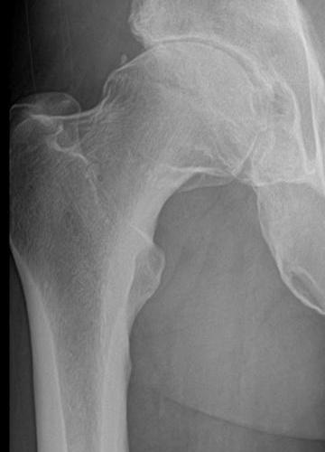 Before treatment - Total Hip Replacement