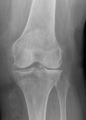 Before a Total Knee Replacement