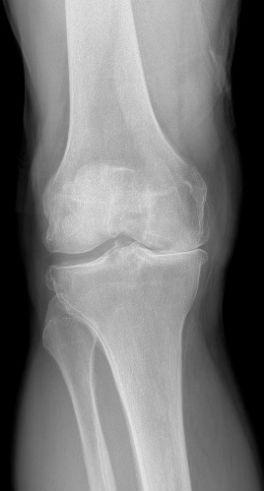 Before treatment - Total Knee Replacement